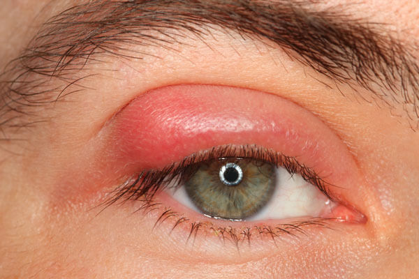 Cirugía Orzuelo Chalazion EN La Paz y el Alto Bolivia