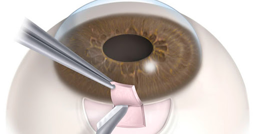 Blefaroplastia en el Alto Bolivia